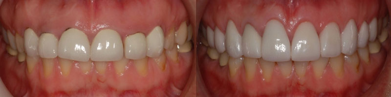 Esthetic Crown Lengthening