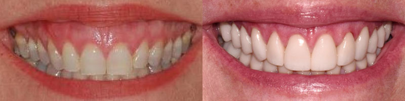 Esthetic Crown Lengthening