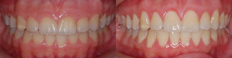 Esthetic Crown Lengthening