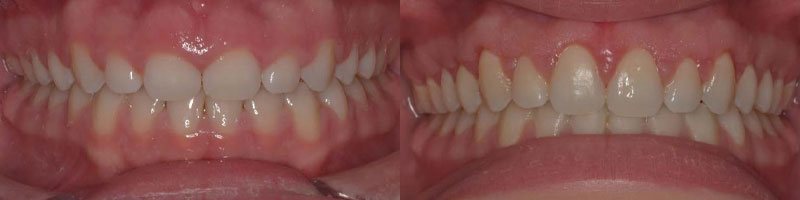 Esthetic Crown Lengthening