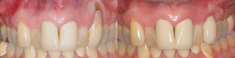 Tissue Grafting